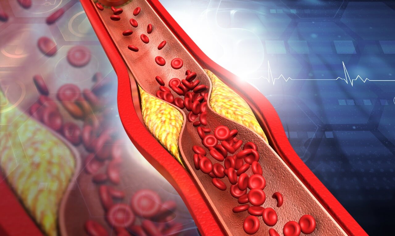 Colesterol: entenda quando ele se torna um problema