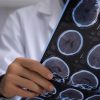 Esclerose múltipla: especialista esclarece mitos e verdades sobre a doença
