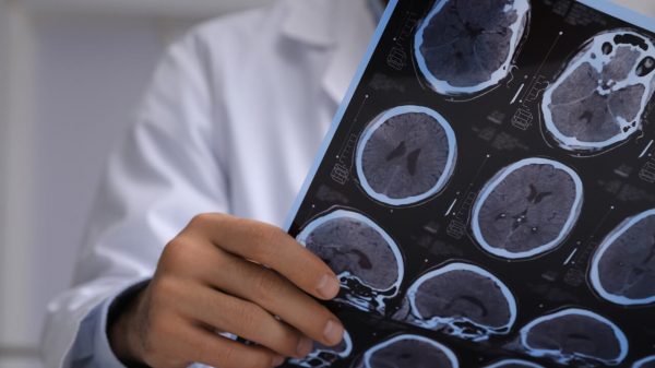 Esclerose múltipla: especialista esclarece mitos e verdades sobre a doença