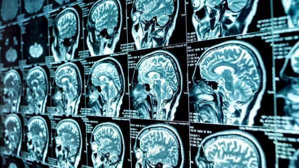 Covid-19 causa problemas neurológicos em mais de 30% dos pacientes, aponta estudo