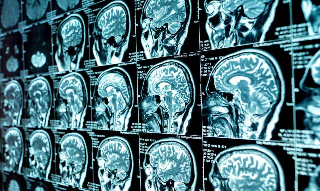 Covid-19 causa problemas neurológicos em mais de 30% dos pacientes, aponta estudo