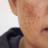 Melasma: máscara facial reduz as manchas escuras