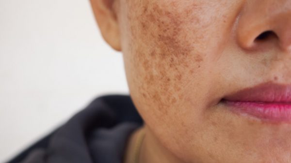Melasma: máscara facial reduz as manchas escuras