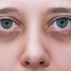Dermatologistas ensinam como tratar os diferentes tipos de olheiras