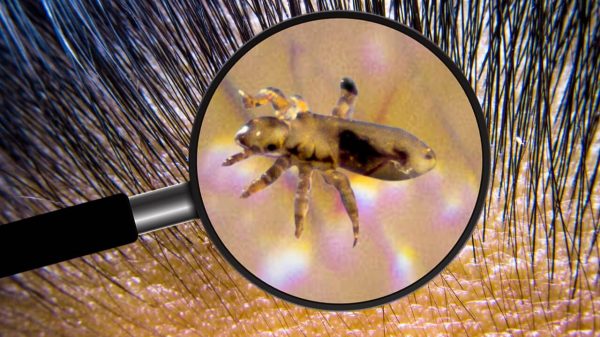 Piolhos: entenda como acontece infestação por insetos nos cabelos