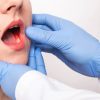 Câncer de boca: sintomas, causas, diagnóstico e tratamento