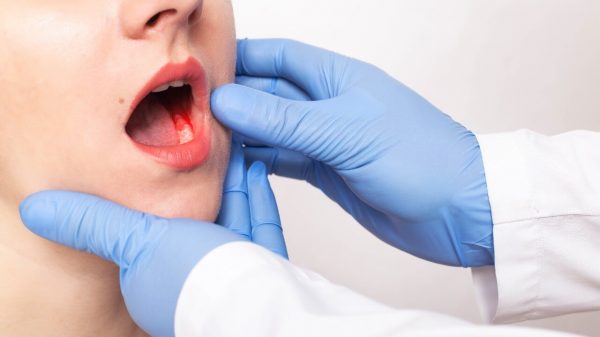 Câncer de boca: sintomas, causas, diagnóstico e tratamento