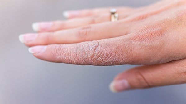 Dermatologista explica o que pode causar a disidrose