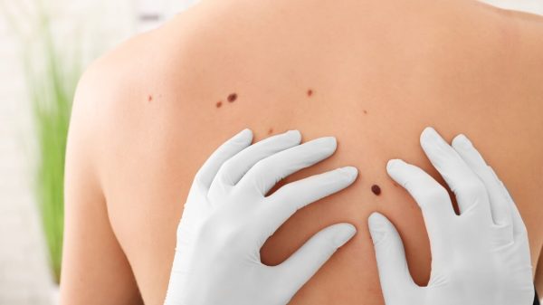 Dezembro Laranja: saiba como se proteger do câncer de pele
