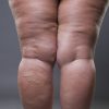 Lipedema: saiba o que causa o acúmulo de gordura no corpo