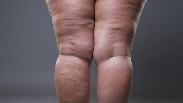 Tudo sobre lipedema - Saúde em Dia