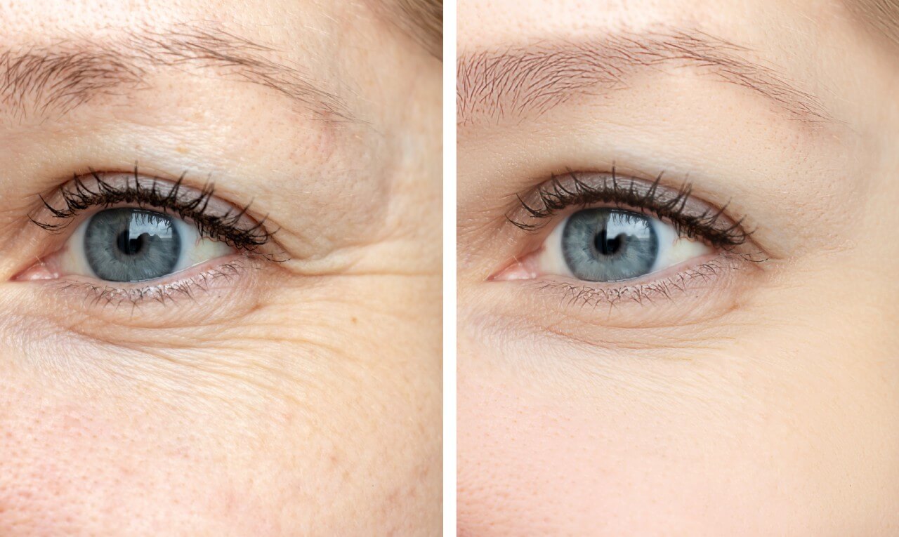 Como evitar rugas e outros problemas na região dos olhos?