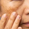 Melasma: sol do verão pode causar manchas escuras na pele