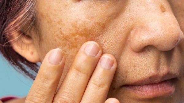 Melasma: sol do verão pode causar manchas escuras na pele