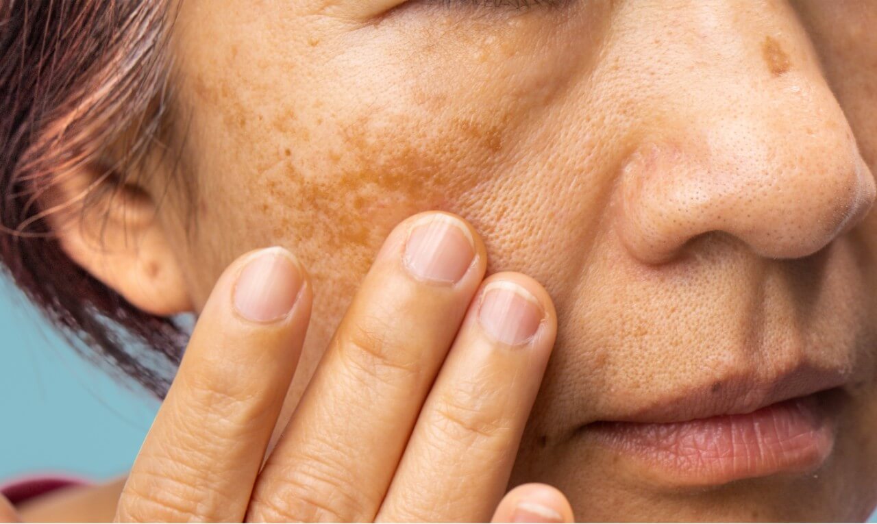 Melasma: sol do verão pode causar manchas escuras na pele
