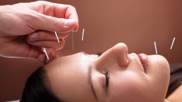 Acupuntura estética: conheça procedimento focado na beleza