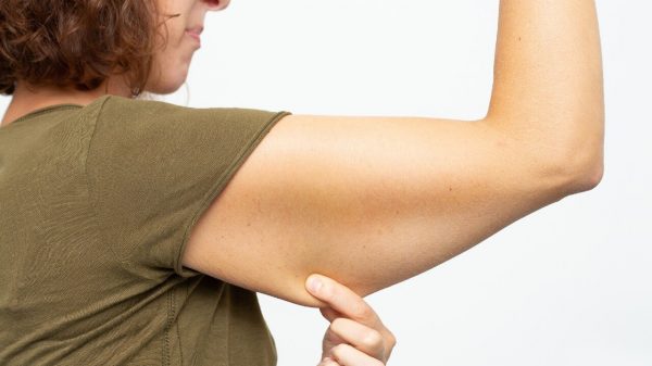 Renuvion: nova tecnologia pode tratar flacidez do braço
