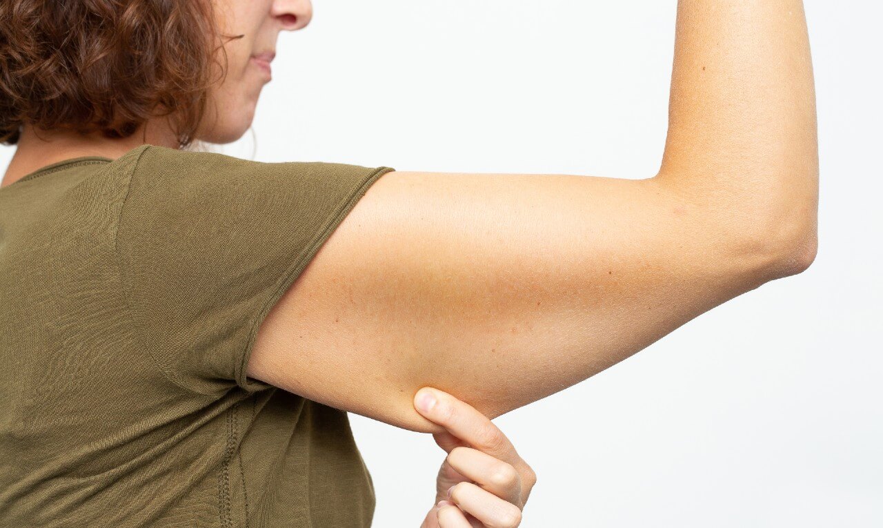 Renuvion: nova tecnologia pode tratar flacidez do braço