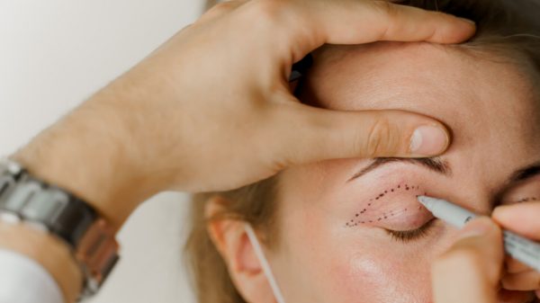 Blefaroplastia: como é o procedimento que rejuvenesce a face