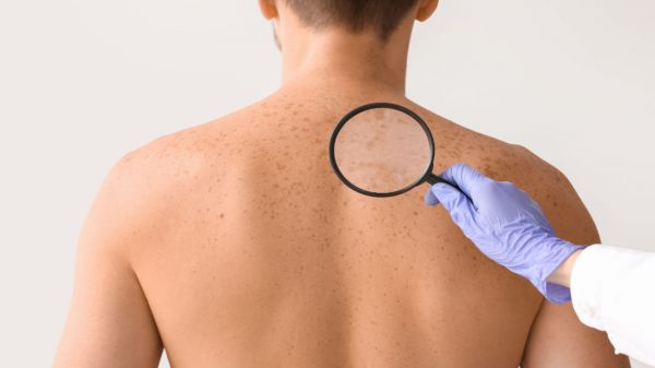 Câncer de pele: sintomas, tipos, tratamento e cuidados