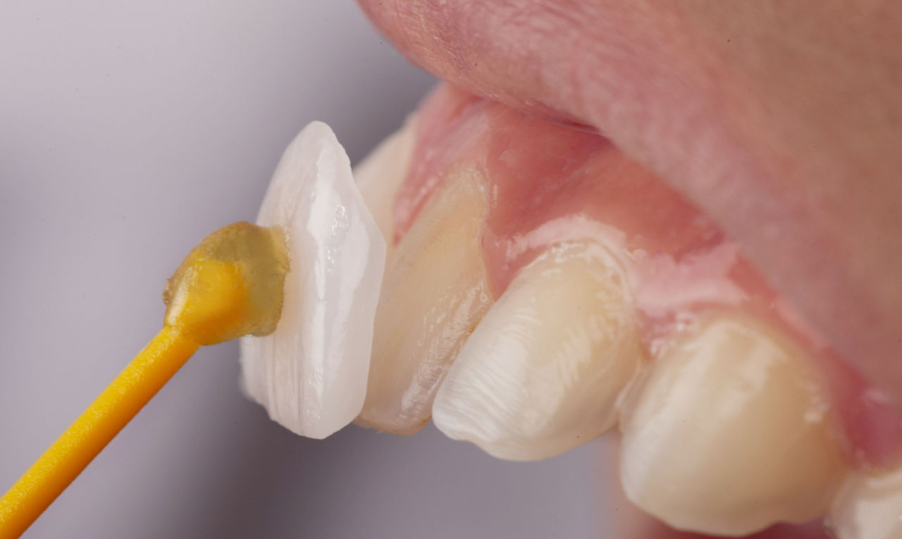 Lente de contato dental realmente desgasta os dentes? Entenda