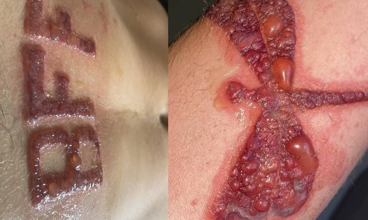 Tatuagem de henna é comum no verão, mas oferece riscos à pele