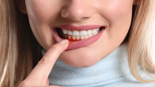 Da gengivite a perda de um dente: entenda a doença periodontal
