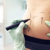 Cirurgia devolve autoestima após o parto: o que é o mommy makeover?