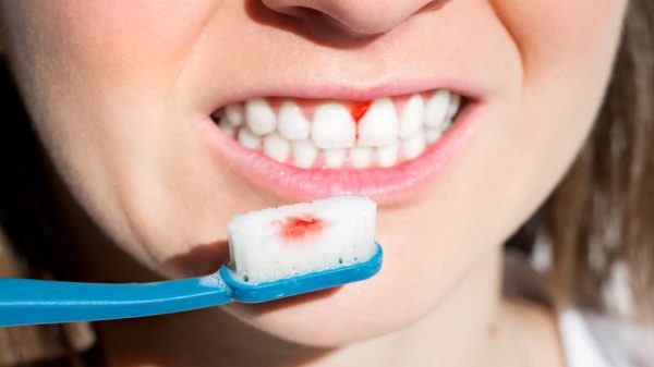Gengiva sangrando após escovação é normal? Dentista responde