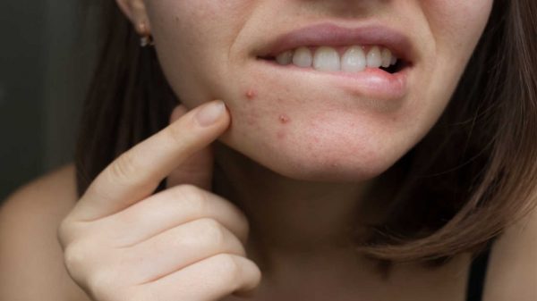 Vitamina B12 pode agravar acne; saiba quais alimentos têm o nutriente