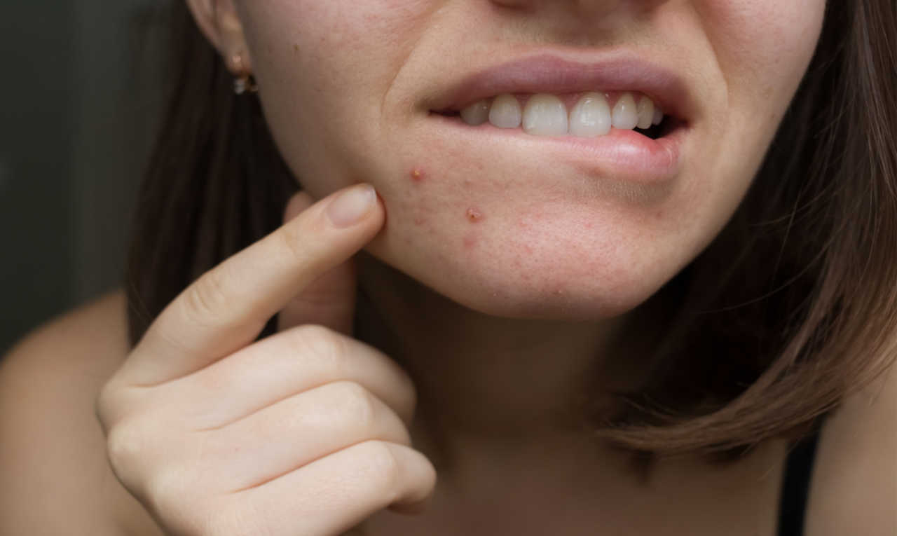 Vitamina B12 pode agravar acne; saiba quais alimentos têm o nutriente