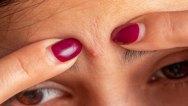 Acne pode ser porta de entrada para bactérias? Entenda