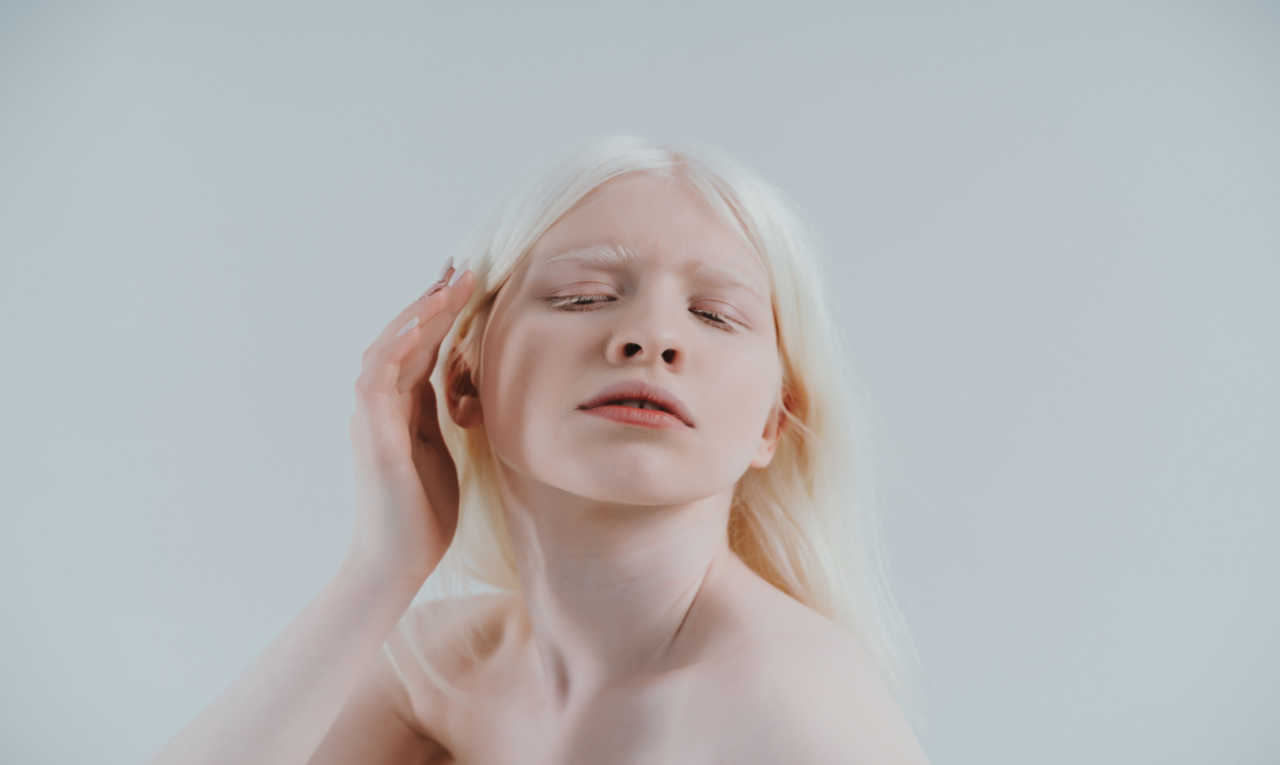 Dia do Albinismo: quais os cuidados necessários com a pele albina?