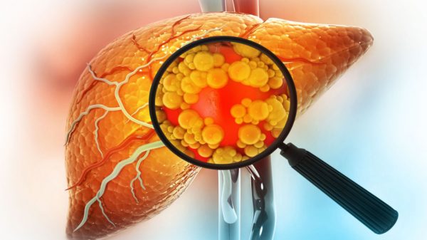 Esteatose hepática: 30% da população brasileira tem gordura no fígado