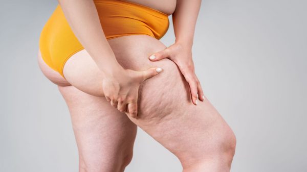 Não é obesidade, é lipedema: saiba como combater o acúmulo de gordura