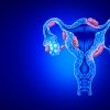 Endometriose pode ser causada por bactérias, revela estudo