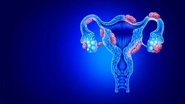 Endometriose pode ser causada por bactérias, revela estudo