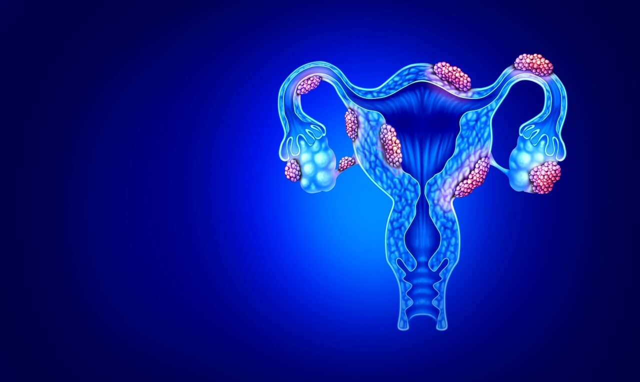 Endometriose pode ser causada por bactérias, revela estudo