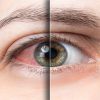 Sintomas da síndrome do olho seco pioram em julho; veja como prevenir