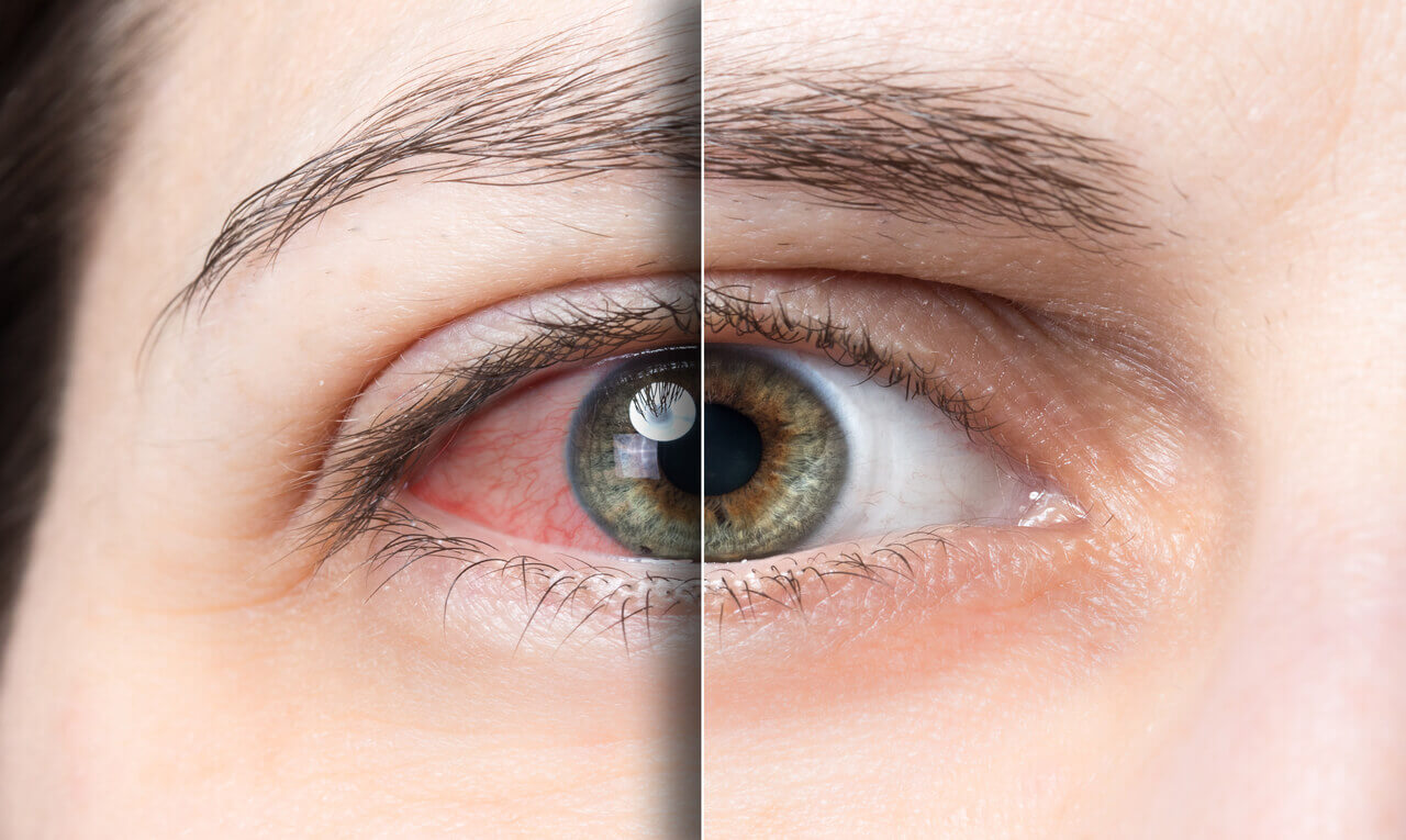 Sintomas da síndrome do olho seco pioram em julho; veja como prevenir