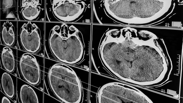 Traumatismo craniano: saiba como é o tratamento e recuperação do paciente