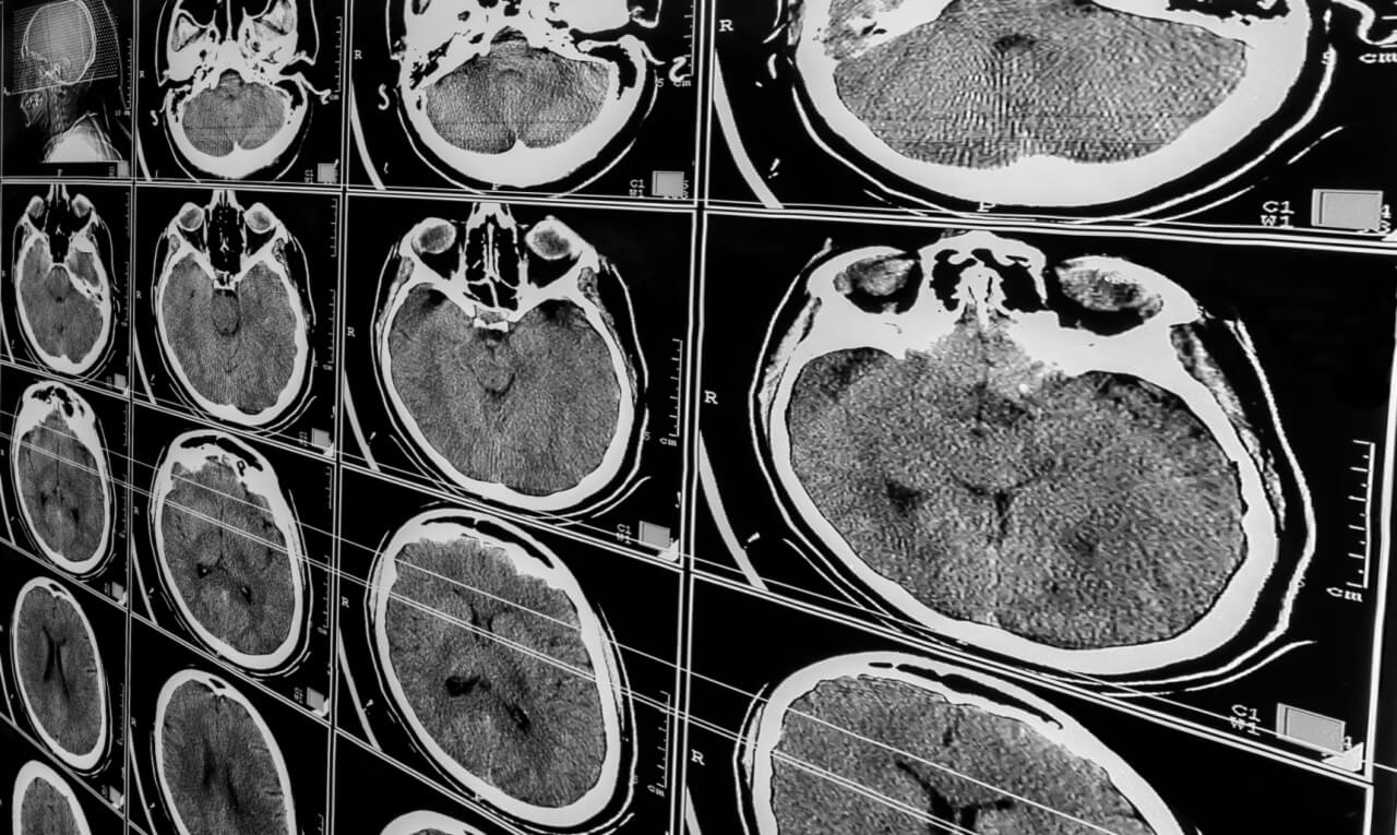 Traumatismo craniano: saiba como é o tratamento e recuperação do paciente