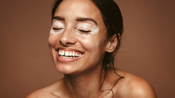 Dia Nacional do Vitiligo: sintomas, diagnóstico e tratamento