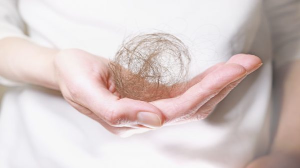 Alopecia atinge 42 milhões de brasileiros; veja como tratar