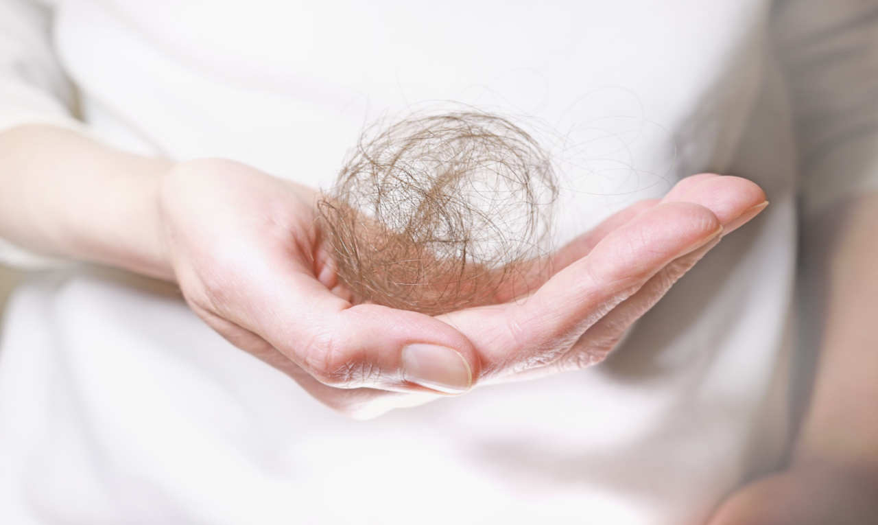 Alopecia atinge 42 milhões de brasileiros; veja como tratar