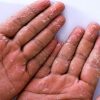 Coceira e bolhas nas mãos: conheça os sintomas da disidrose