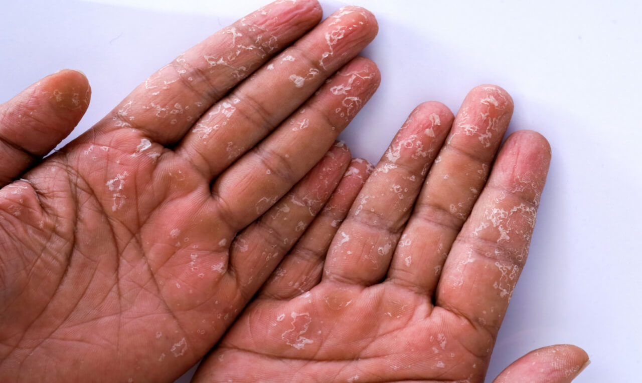 Coceira e bolhas nas mãos: conheça os sintomas da disidrose