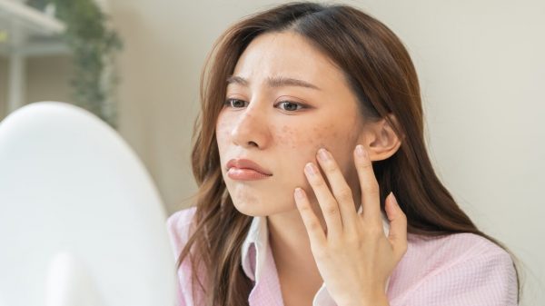 Por que o inverno é a melhor época para tratar o melasma? Entenda