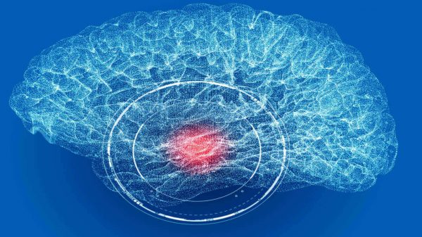 Alerta: dor de cabeça sem melhora pode indicar aneurisma cerebral