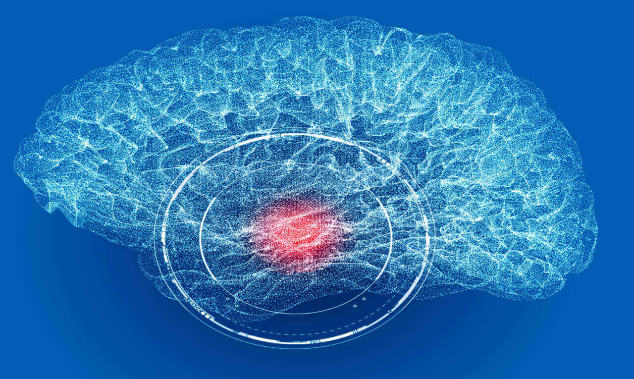 Alerta: dor de cabeça sem melhora pode indicar aneurisma cerebral